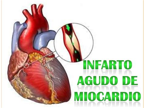 Infarto Agudo Do Miocardio Nbkomputer