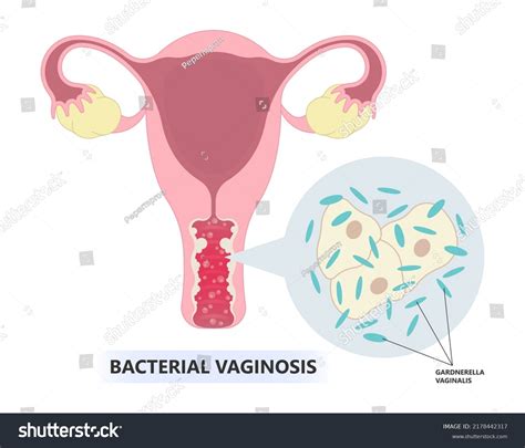 Im Genes Fotos De Stock Objetos En D Y Vectores Sobre Vaginosis