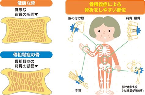 骨粗鬆症の予防と治療に栄養は大事！ 風間内科医院