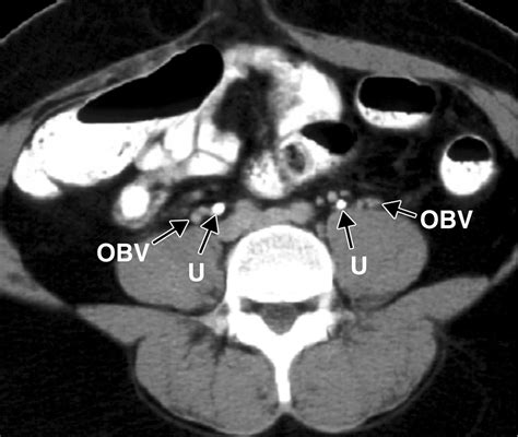 Recognition Of The Ovaries And Ovarian Origin Of Pelvic Masses With CT