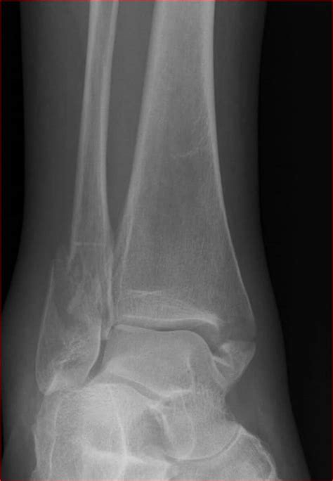 INJURIES AROUND THE ANKLE (Pott’s Fracture) - www.medicoapps.org