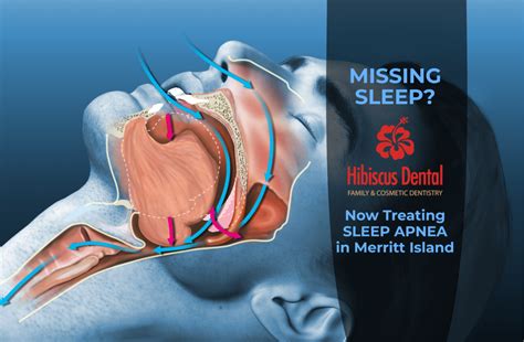 Dental Solutions For Obstructive Sleep Apnea Hibiscus Dental