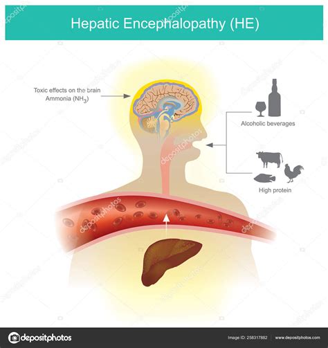 Hepatic Encephalopathy Pathophysiology