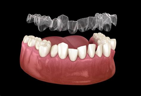 Invisalign Results Overbite