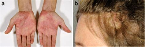 A Paradoxical Psoriasis Induced By A Tnf Antagonist B Paradoxical Download Scientific Diagram