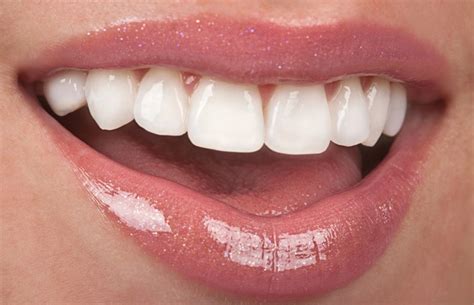 Carillas Dentales Qué son y cómo mejoran tu sonrisa