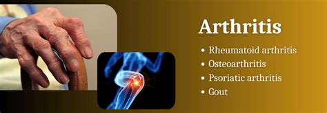 Best Arthritis Treatment Dubai Ayurveda Clinic Dubai Ayurveda Care