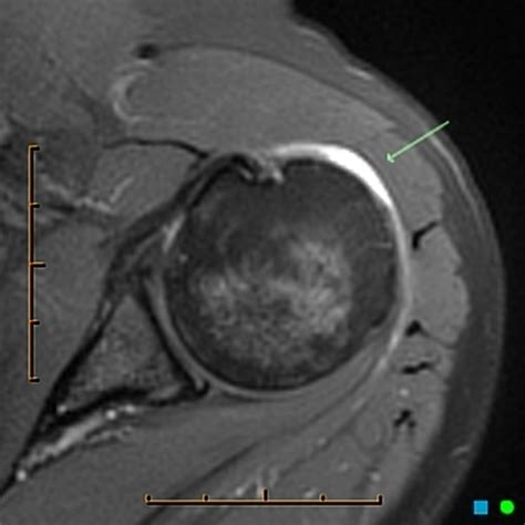 Mri Shoulder Bursitis