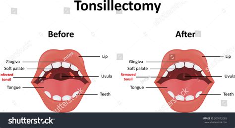 Tonsillectomy Stock Illustration 307672085 Shutterstock