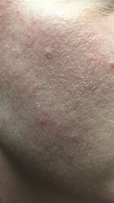 Rosacea and makeup- how to help with dry flakey skin. Any advice? : r ...