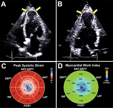 Myocardial Work In Apical Hypertrophic Cardiomyopathy Journal Of The