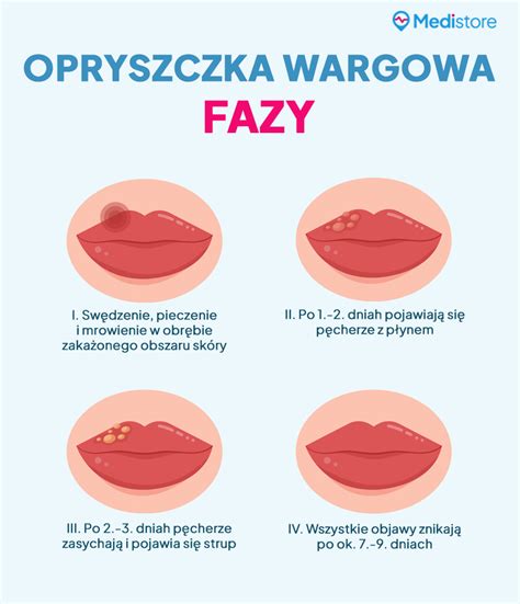 Opryszczka Przyczyny Objawy Leczenie Medistore