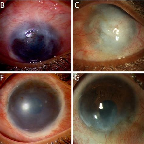 Clinical Photographs Of Eyes Before And After Autologous Cultivated