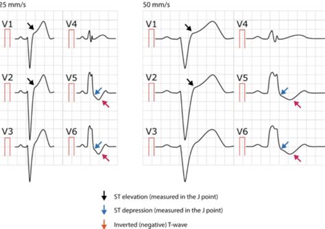 Ischemia Heart Disease And Acute Coronary Syndrome Stable Angina