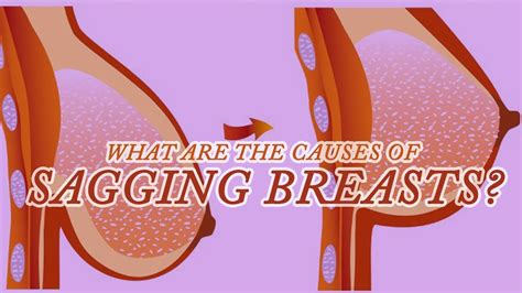 What Are The Causes Of Sagging Breasts Breast Care Youtube