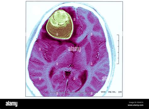 CYST IN THE BRAIN, MRI Stock Photo - Alamy