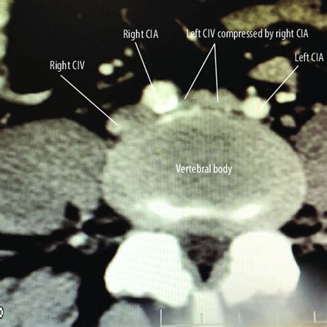 A Ct Scan Axial View Showing Compression Of Left Common Iliac Vein