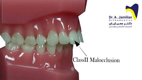 Malocclusion Class 2 Dr Jamilian