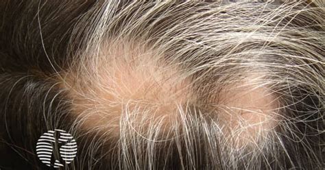 Alopecia Areata Image
