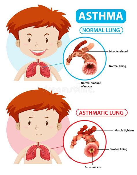 Asthmadiagramm Mit Normaler Lunge Und Asthmatischer Lunge Vektor