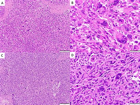 Spindle Cell Neoplasm With Pleomorphic Epithelioid Features