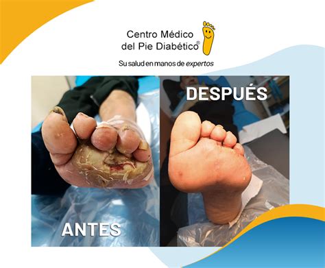 Ulceras Pie Diabético Centro Médico del Pie Diabético