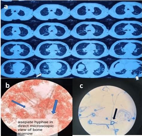 A Multiaxial Ct Chest Parenchymal View Showing Ground Glass Opacity Download Scientific