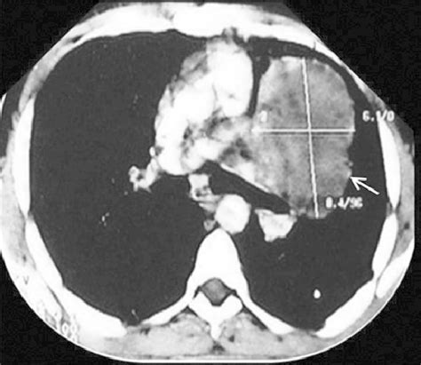 Contrast Enhanced Ct Thorax Showing A Hypodense Mass Lesion Measuring