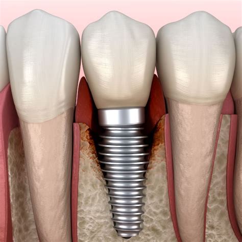 What Is Peri Implantitis And What To Do About It Md Periodontics