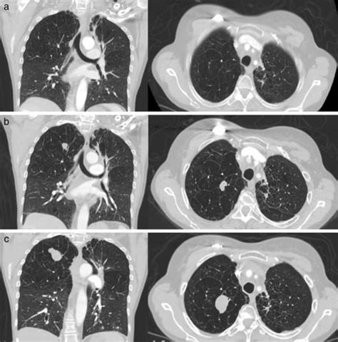 Incidental Early Diagnosis Of Biphasic Pulmonary Blastoma In A Patient With History Of Stage Iv