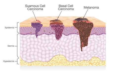 Skin Cancer Chatswood Skin Cancer Clinic