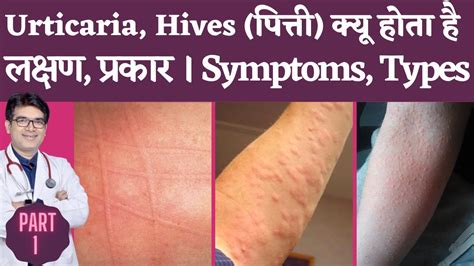 Skin Rash Urticaria Hives Causes Types Symptoms I Urticaria Hives