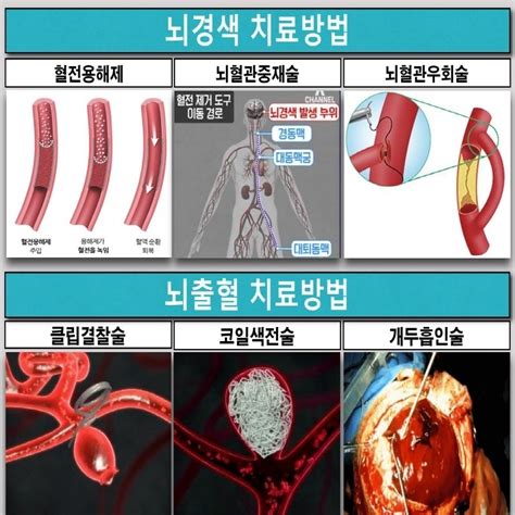 혈관질환뇌 심장 정보 앎