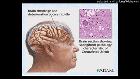 Prion Diseases Or Transmissible Spongiform Encephalopathies TSEs