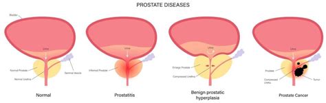 Information About Prostate Bims Hospital