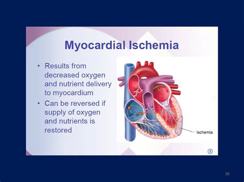 Ekg Myocardial Ischemia And Infarction Ppt