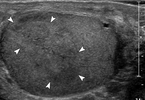 Acute Segmental Testicular Infarction At Contrast Enhanced Ultrasound