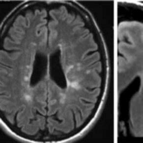 MS gray and white matter lesions in the brain shown by MRI imaging [8 ...