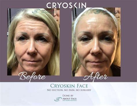 Checkout our Before and After Cryoskin Face Results