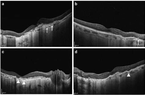 Oct Picture Showing Breaks In Bruchs Membrane Download Scientific Diagram