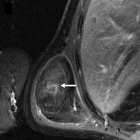 Fat Containing Lesions In Adult Thoracic Imaging Ajr