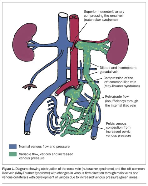 Anatomical Abnormalities Of The Pelvic Venous System And Their The