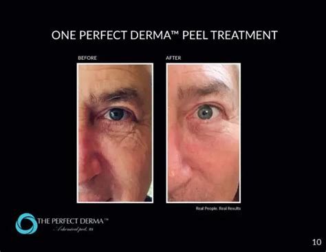 Century Derma Lounge | The Perfect Derma Peel