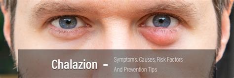 Chalazion Symptoms Causes Risk Factors And Prevention Tips