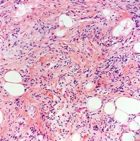 Types Of Lipoma Pathology Outlines Infoupdate Org