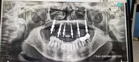集采新政 普惠民生丨我院口腔科成功完成一例上颌半口即拔即种即刻修复手术 广东省人民医院赣州医院（赣州市立医院）