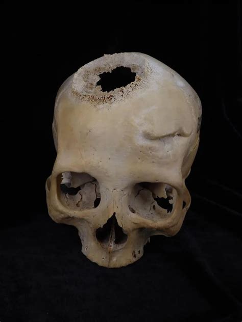 Un Joven De 30 Años Del Antiguo Egipto Primer Paciente Operado De Cáncer Hace 4 500 Años Infobae