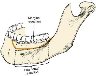 Reconstruction Of The Mandible Clinical Gate