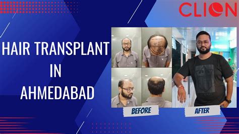 Hair Transplant In Ahmedabad Ahmedabad Hair Transplant Best Result