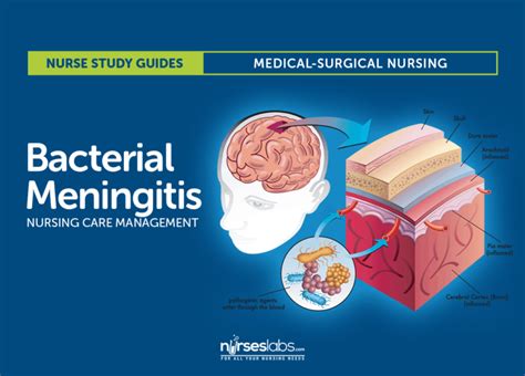 Bacterial Meningitis Nursing Care and Management: Study Guide